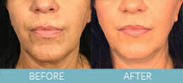 Exilis Ultra™ Skin Tightening Gallery