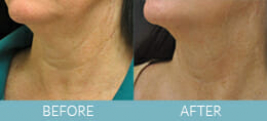 Exilis Ultra™ Skin Tightening Gallery