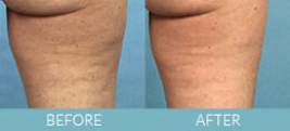 Cellulite Treatment Gallery