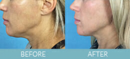 Exilis Ultra™ Skin Tightening Gallery