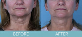 Exilis Ultra™ Skin Tightening Gallery