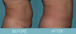 SmartLipo™ Gallery