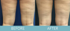 Cellulite Treatment Gallery