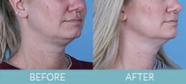 Exilis Ultra™ Skin Tightening Gallery