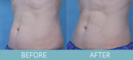 Exilis Ultra™ Skin Tightening Gallery