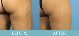 Cellulite Treatment Gallery