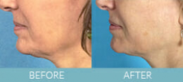 Exilis Ultra™ Skin Tightening Gallery