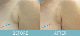 Exilis Ultra™ Skin Tightening Gallery