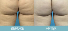 Cellulite Treatment Gallery