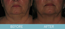 Skin Tightening Gallery