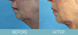 Skin Tightening Gallery