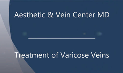 Treatment of Varicose Veins