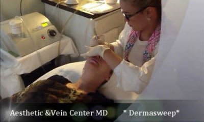 Dermasweep Procedure