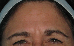 Before BOTOX® Cosmetic by Dr. Normand Miller, Salem, NH and Nashua, NH