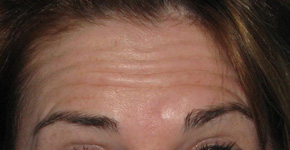 Before BOTOX® Cosmetic by Dr. Normand Miller, Salem, NH and Nashua, NH