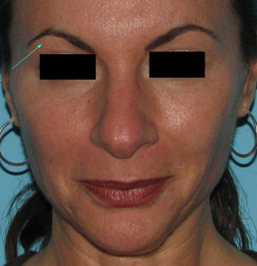 After BOTOX® Cosmetic by Dr. Normand Miller, Salem, NH and Nashua, NH