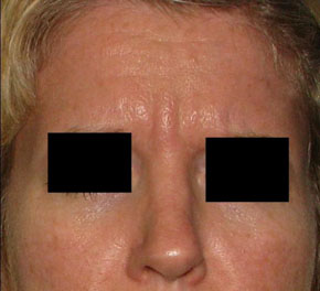 Before BOTOX® Cosmetic by Dr. Normand Miller, Salem, NH and Nashua, NH