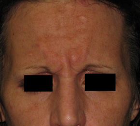 Before BOTOX® Cosmetic by Dr. Normand Miller, Salem, NH and Nashua, NH