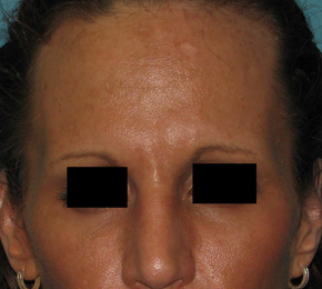 After BOTOX® Cosmetic by Dr. Normand Miller, Salem, NH and Nashua, NH