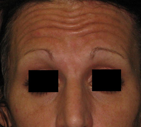 Before BOTOX® Cosmetic by Dr. Normand Miller, Salem, NH and Nashua, NH