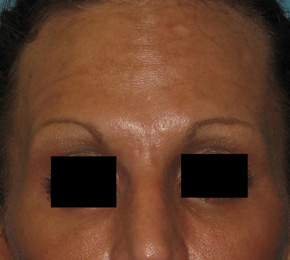 After BOTOX® Cosmetic by Dr. Normand Miller, Salem, NH and Nashua, NH