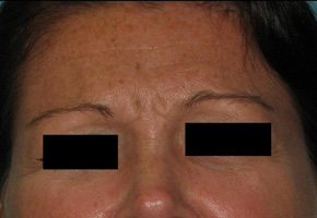 Before BOTOX® Cosmetic by Dr. Normand Miller, Salem, NH and Nashua, NH