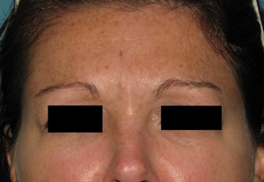 After BOTOX® Cosmetic by Dr. Normand Miller, Salem, NH and Nashua, NH