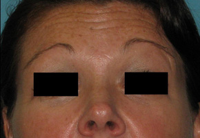 Before BOTOX® Cosmetic by Dr. Normand Miller, Salem, NH and Nashua, NH