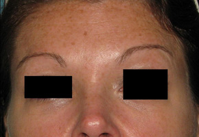 After BOTOX® Cosmetic by Dr. Normand Miller, Salem, NH and Nashua, NH