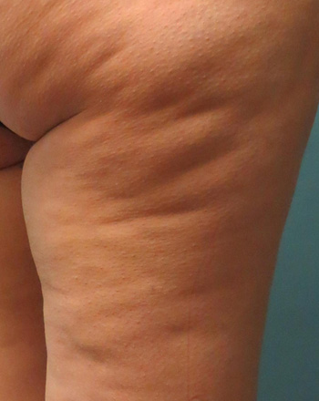 Before Cellulite Treatment by Dr. Normand Miller, Salem, NH and Nashua, NH