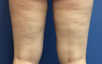 Before Cellulite Treatment by Dr. Normand Miller, Salem, NH and Nashua, NH