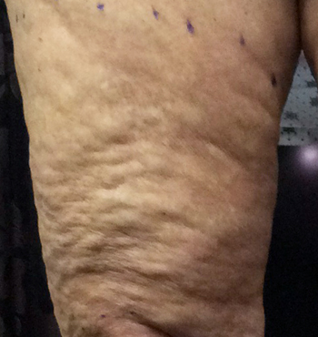 Before Cellulite Treatment by Dr. Normand Miller, Salem, NH and Nashua, NH