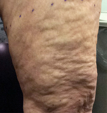 Before Cellulite Treatment by Dr. Normand Miller, Salem, NH and Nashua, NH