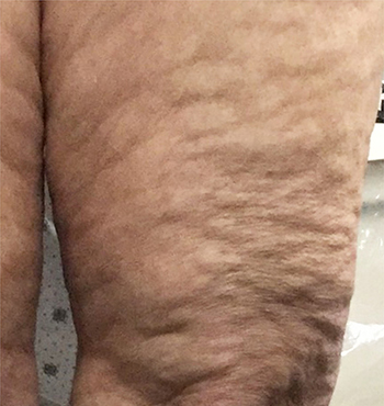 After Cellulite Treatment by Dr. Normand Miller, Salem, NH and Nashua, NH