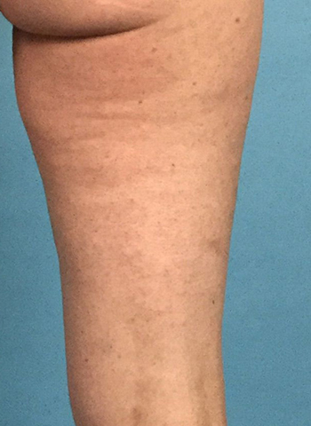 After Cellulite Treatment by Dr. Normand Miller, Salem, NH and Nashua, NH