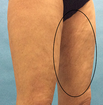 After Cellulite Treatment by Dr. Normand Miller, Salem, NH and Nashua, NH