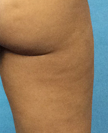 After Cellulite Treatment by Dr. Normand Miller, Salem, NH and Nashua, NH