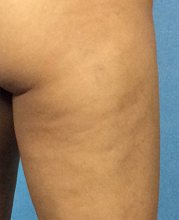 Before Cellulite Treatment by Dr. Normand Miller, Salem, NH and Nashua, NH