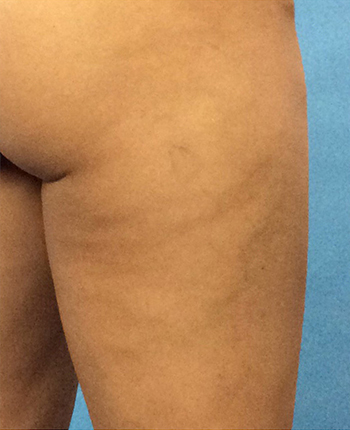 After Cellulite Treatment by Dr. Normand Miller, Salem, NH and Nashua, NH