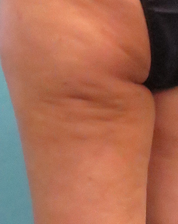 Cellulite Treatment Treatment Before & After