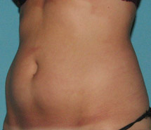 Before CoolSculpting® by Dr. Normand Miller, Salem, NH and Nashua, NH