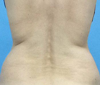 Before CoolSculpting® by Dr. Normand Miller, Salem, NH and Nashua, NH