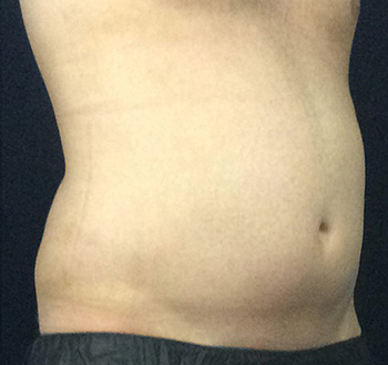 Before CoolSculpting® by Dr. Normand Miller, Salem, NH and Nashua, NH