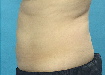 After CoolSculpting® by Dr. Normand Miller, Salem, NH and Nashua, NH