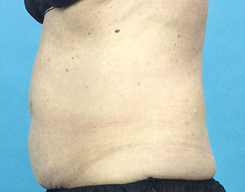 Before CoolSculpting® by Dr. Normand Miller, Salem, NH and Nashua, NH