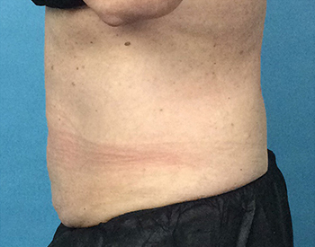 After CoolSculpting® by Dr. Normand Miller, Salem, NH and Nashua, NH
