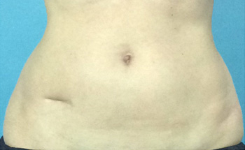 Before CoolSculpting® by Dr. Normand Miller, Salem, NH and Nashua, NH