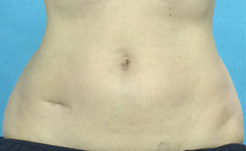 After CoolSculpting® by Dr. Normand Miller, Salem, NH and Nashua, NH