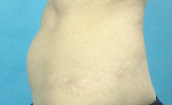 Before CoolSculpting® by Dr. Normand Miller, Salem, NH and Nashua, NH