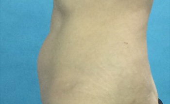 After CoolSculpting® by Dr. Normand Miller, Salem, NH and Nashua, NH